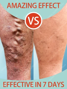 Učinkovito Krčnih Veno Olajšave Krema Za Odpravo Vaskulitis Phlebitis Pajkove Noge Zdravljenje Pomirja Lajšanje Bolečin